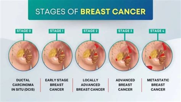 How has breast cancer treatment changed over the years?